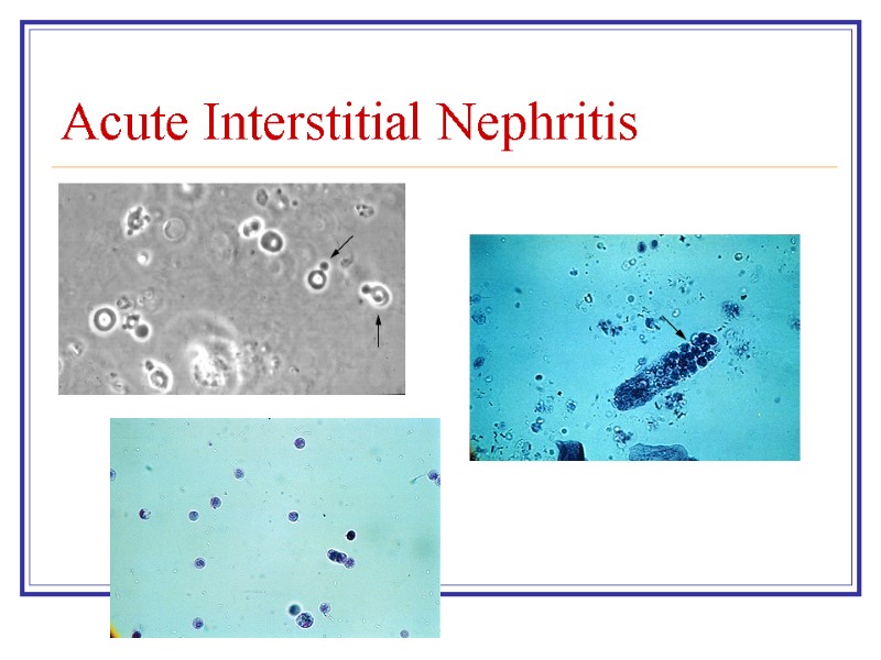 Acute Interstitial Nephritis